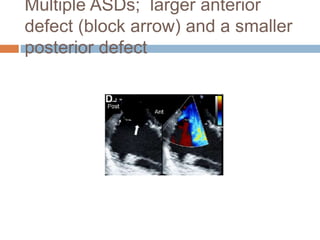 Multiple ASDs; larger anterior
defect (block arrow) and a smaller
posterior defect
 