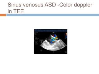 Sinus venosus ASD -Color doppler
in TEE
 