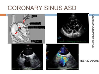 CORONARY SINUS ASD
DILATEDCORONARYSINUS
TEE 120 DEGREE
 