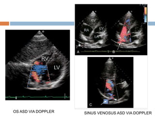 OS ASD VIA DOPPLER SINUS VENOSUS ASD VIA DOPPLER
 