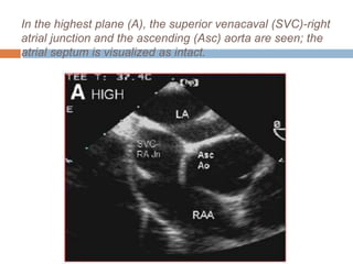 In the highest plane (A), the superior venacaval (SVC)-right
atrial junction and the ascending (Asc) aorta are seen; the
atrial septum is visualized as intact.
 