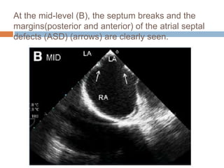 At the mid-level (B), the septum breaks and the
margins(posterior and anterior) of the atrial septal
defects (ASD) (arrows) are clearly seen.
 