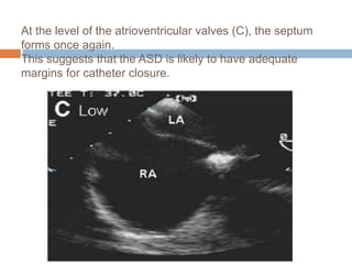 At the level of the atrioventricular valves (C), the septum
forms once again.
This suggests that the ASD is likely to have adequate
margins for catheter closure.
 