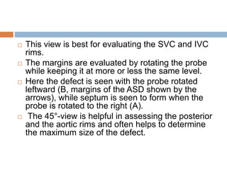  This view is best for evaluating the SVC and IVC
rims.
 The margins are evaluated by rotating the probe
while keeping it at more or less the same level.
 Here the defect is seen with the probe rotated
leftward (B, margins of the ASD shown by the
arrows), while septum is seen to form when the
probe is rotated to the right (A).
 The 45°-view is helpful in assessing the posterior
and the aortic rims and often helps to determine
the maximum size of the defect.
 