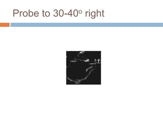 Probe to 30-40o right
 