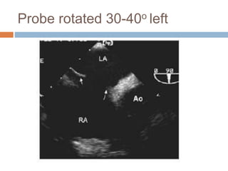 Probe rotated 30-40o left
 