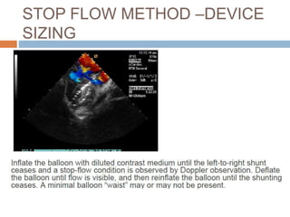 STOP FLOW METHOD –DEVICE
SIZING
 