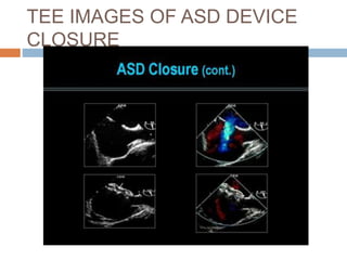 TEE IMAGES OF ASD DEVICE
CLOSURE
 
