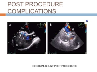 POST PROCEDURE
COMPLICATIONS
RESIDUAL SHUNT POST PROCEDURE
 