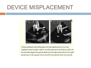 DEVICE MISPLACEMENT
 