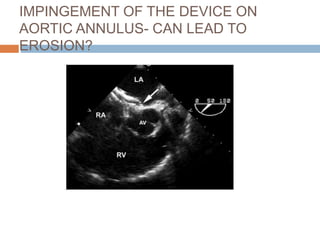 IMPINGEMENT OF THE DEVICE ON
AORTIC ANNULUS- CAN LEAD TO
EROSION?
 