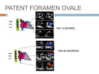 PATENT FORAMEN OVALE
TEE -0 DEGREE
TEE-90 DEGREES
 