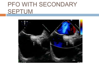 PFO WITH SECONDARY
SEPTUM
 
