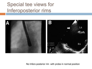 Special tee views for
Inferoposterior rims
No Infero posterior rim with probe in normal position
 