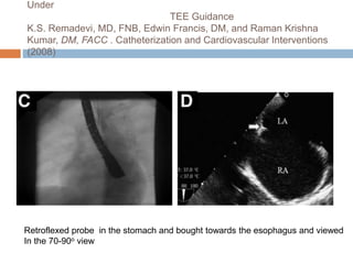 Under
TEE Guidance
K.S. Remadevi, MD, FNB, Edwin Francis, DM, and Raman Krishna
Kumar, DM, FACC . Catheterization and Cardiovascular Interventions
(2008)
Retroflexed probe in the stomach and bought towards the esophagus and viewed
In the 70-90o view
 