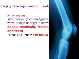 Imaging technology is used in medicine
X-ray images
use x-rays (electromagnetic
wave of high energy) to show
dense materials, bones
and teeth
- Does NOT show soft tissue