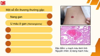 Một số tổn thương thường gặp:
Nang gan
U máu ở gan (Hemangioma)
Đặc điểm: u mạch máu lành tính
Nguyên nhân: dị dạng mạch máu
 