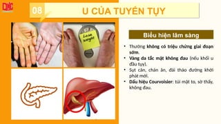 Add title!
Lorem ipsum dolor sit amet,
consectetuer adipiscing elit. Maecenas
porttitor congue massa. Fusce posuere,
magna sed pulvinar ultricies, purus lectus
malesuada libero, sit amet commodo
magna eros quis urna.
• Thường không có triệu chứng giai đoạn
sớm.
• Vàng da tắc mật không đau (nếu khối u
đầu tụy).
• Sụt cân, chán ăn, đái tháo đường khởi
phát mới.
• Dấu hiệu Courvoisier: túi mật to, sờ thấy,
không đau.
08 U CỦA TUYẾN TỤY
Biểu hiện lâm sàng
 