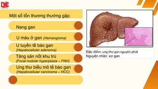 Một số tổn thương thường gặp:
Tăng sản nốt khu trú
(Focal nodular hyperplasia – FNH)
U máu ở gan (Hemangioma)
U tuyến tế bào gan
(Hepatocellular adenoma)
Nang gan
Đặc điểm: ung thư gan nguyên phát
Nguyên nhân: xơ gan
Ung thư biểu mô tế bào gan
(Hepatocellular carcinoma – HCC)
 