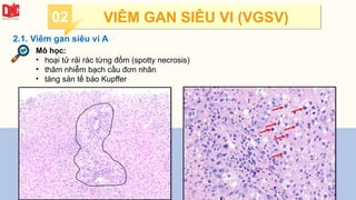 2.1. Viêm gan siêu vi A
Mô học:
• hoại tử rải rác từng đốm (spotty necrosis)
• thâm nhiễm bạch cầu đơn nhân
• tăng sản tế bào Kupffer
02 VIÊM GAN SIÊU VI (VGSV)
 