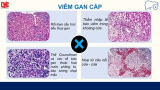 VIÊM GAN CẤP
Rối loạn cấu trúc
tiểu thuỳ gan
Thấm nhập tế
bào viêm trong
khoảng cửa
Thể Councilman
và các tế bào
gan thoái hoá
nước phồng to,
bào tương nhạt
mầu
Hoại tử cầu nối
cửa - cửa
 