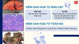 VIÊM GAN HOẠI TỬ BÁN CẤP
Đại thể
Gan teo nhỏ, mặt cắt có
nhiều hạt.
Vi thể
Hoại tử bắc cầu: các dải tế bào
hoại tử nối giữa tĩnh mạch
trung tâm và khoảng cửa.
VIÊM GAN HOẠI TỬ TOÀN BỘ
Là bệnh cảnh nặng gây tử vong rất cao, nhất là ở bệnh nhân già.
 