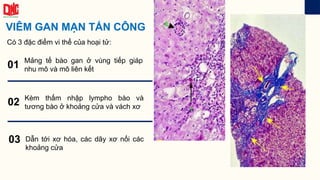 VIÊM GAN MẠN TẤN CÔNG
01
02
03
Có 3 đặc điểm vi thể của hoại tử:
Mảng tế bào gan ở vùng tiếp giáp
nhu mô và mô liên kết
Kèm thấm nhập lympho bào và
tương bào ở khoảng cửa và vách xơ
Dẫn tới xơ hóa, các dãy xơ nối các
khoảng cửa
 