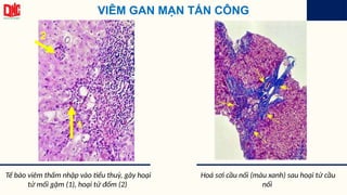 VIÊM GAN MẠN TẤN CÔNG
Tế bào viêm thấm nhập vào tiểu thuỳ, gây hoại
tử mối gặm (1), hoại tử đốm (2)
Hoá sơi cầu nối (màu xanh) sau hoại tử cầu
nối
1
2
 