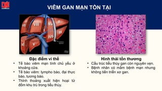 VIÊM GAN MẠN TỒN TẠI
Đặc điểm vi thể
• Tế bào viêm mạn tính chủ yếu ở
khoảng cửa.
• Tế bào viêm: lympho bào, đại thực
bào, tương bào.
• Thỉnh thoảng xuất hiện hoại tử
đốm khu trú trong tiểu thùy.
Hình thái tổn thương
• Cấu trúc tiểu thùy gan còn nguyên vẹn.
• Bệnh nhân có mầm bệnh mạn nhưng
không tiến triển xơ gan.
 