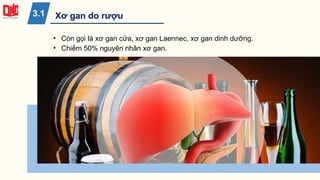 • Còn gọi là xơ gan cửa, xơ gan Laennec, xơ gan dinh dưỡng.
• Chiếm 50% nguyên nhân xơ gan.
Xơ gan do rượu
3.1
 