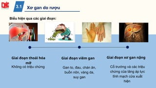 Giai đoạn thoái hóa
mỡ
Không có triệu chứng
Giai đoạn viêm gan
Gan to, đau, chán ăn,
buồn nôn, vàng da,
suy gan
Giai đoạn xơ gan nặng
Cổ trướng và các triệu
chứng của tăng áp lực
tĩnh mạch cửa xuất
hiện
Biểu hiện qua các giai đoạn:
Xơ gan do rượu
3.1
 