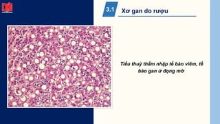 Xơ gan do rượu
3.1
Tiểu thuỳ thấm nhập tế bào viêm, tế
bào gan ứ đọng mỡ
 