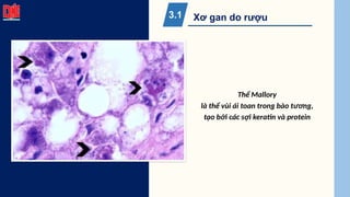 Xơ gan do rượu
3.1
Thể Mallory
là thể vùi ái toan trong bào tương,
tạo bởi các sợi keratin và protein
 