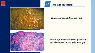 Xơ gan do rượu
3.1
Xơ gan rượu giai đoạn nốt nhỏ
Các dải sợi (mầu xanh) bao quanh các
nốt tế bào gan tái tạo (tiểu thuỳ giả)
 