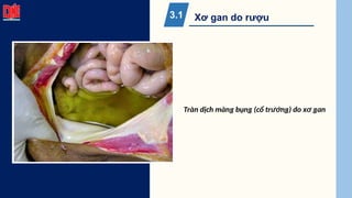 Xơ gan do rượu
3.1
Tràn dịch màng bụng (cổ trướng) do xơ gan
 