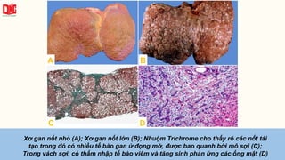 Xơ gan nốt nhỏ (A); Xơ gan nốt lớn (B); Nhuộm Trichrome cho thấy rõ các nốt tái
tạo trong đó có nhiều tế bào gan ứ đọng mỡ, được bao quanh bởi mô sợi (C);
Trong vách sợi, có thấm nhập tế bào viêm và tăng sinh phản ứng các ống mật (D)
A B
C D
 