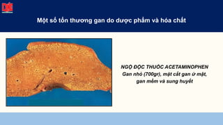 NGỘ ĐỘC THUỐC ACETAMINOPHEN
Gan nhỏ (700gr), mặt cắt gan ứ mật,
gan mềm và sung huyết
Một số tổn thương gan do dược phẩm và hóa chất
 