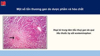 Hoại tử trung tâm tiểu thuỳ gan do quá
liều thuốc hạ sốt acetaminophen
Một số tổn thương gan do dược phẩm và hóa chất
 