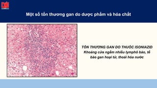 TỔN THƯƠNG GAN DO THUỐC ISONIAZID
Khoảng cửa ngấm nhiều lymphô bào, tế
bào gan hoại tử, thoái hóa nước
Một số tổn thương gan do dược phẩm và hóa chất
 