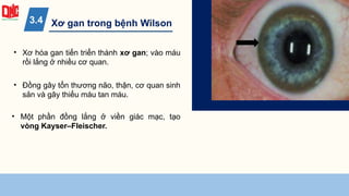 Xơ gan trong bệnh Wilson
3.4
• Xơ hóa gan tiến triển thành xơ gan; vào máu
rồi lắng ở nhiều cơ quan.
• Đồng gây tổn thương não, thận, cơ quan sinh
sản và gây thiếu máu tan máu.
• Một phần đồng lắng ở viền giác mạc, tạo
vòng Kayser–Fleischer.
 