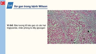 Xơ gan trong bệnh Wilson
3.4
Vi thể: Bào tương tế bào gan có các hạt
triglyceride, nhân phòng to đầy glycogen
 