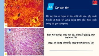Do suy tim ứ huyết ở tim phải kéo dài, gây xuất
huyết và hoại tử vùng trung tâm tiểu thùy, cuối
cùng xơ gan vùng này
Xơ gan tim
3.6
Gan hơi sưng, màu tím đỏ, mặt cắt giống như
hạt cau (A)
Hoại tử trung tâm tiểu thuỳ do thiếu oxy (B)
A
B
 