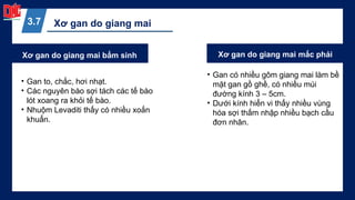 Xơ gan do giang mai
3.7
Xơ gan do giang mai bẩm sinh Xơ gan do giang mai mắc phải
• Gan có nhiều gôm giang mai làm bề
mặt gan gồ ghề, có nhiều múi
đường kính 3 – 5cm.
• Dưới kính hiển vi thấy nhiều vùng
hóa sợi thấm nhập nhiều bạch cầu
đơn nhân.
• Gan to, chắc, hơi nhạt.
• Các nguyên bào sợi tách các tế bào
lót xoang ra khỏi tế bào.
• Nhuộm Levaditi thấy có nhiều xoắn
khuẩn.
 