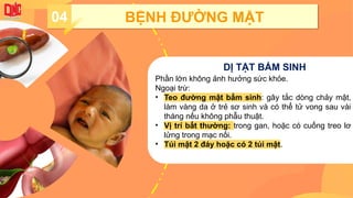 04 BỆNH ĐƯỜNG MẬT
DỊ TẬT BẨM SINH
Phần lớn không ảnh hưởng sức khỏe.
Ngoại trừ:
• Teo đường mật bẩm sinh: gây tắc dòng chảy mật,
làm vàng da ở trẻ sơ sinh và có thể tử vong sau vài
tháng nếu không phẫu thuật.
• Vị trí bất thường: trong gan, hoặc có cuống treo lơ
lửng trong mạc nối.
• Túi mật 2 đáy hoặc có 2 túi mật.
 