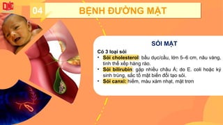 04 BỆNH ĐƯỜNG MẬT
SỎI MẬT
Có 3 loại sỏi
• Sỏi cholesterol: bầu dục/cầu, lớn 5–6 cm, nâu vàng,
tinh thể xếp hàng rào.
• Sỏi bilirubin: gặp nhiều châu Á; do E. coli hoặc ký
sinh trùng, sắc tố mật biến đổi tạo sỏi.
• Sỏi canxi: hiếm, màu xám nhạt, mặt trơn
 