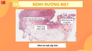 04 BỆNH ĐƯỜNG MẬT
Viêm túi mật cấp tính
Niêm mạc túi mật sưng đỏ
Nhiều bạch cầu
trung tính
Phản ứng
viêm mạnh
 