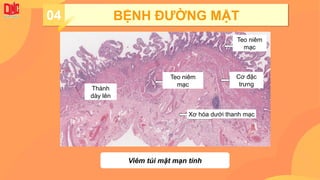 04 BỆNH ĐƯỜNG MẬT
Viêm túi mật mạn tính
Xơ hóa dưới thanh mạc
Teo niêm
mạc
Thành
dày lên
Teo niêm
mạc
Cơ đặc
trưng
 