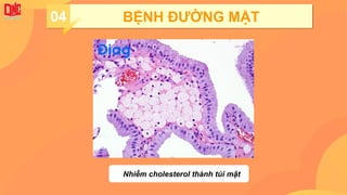 04 BỆNH ĐƯỜNG MẬT
Nhiễm cholesterol thành túi mật
 