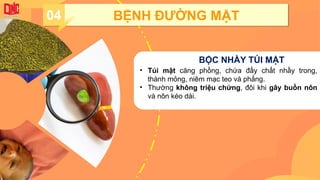 04 BỆNH ĐƯỜNG MẬT
BỘC NHẦY TÚI MẬT
• Túi mật căng phồng, chứa đầy chất nhầy trong,
thành mỏng, niêm mạc teo và phẳng.
• Thường không triệu chứng, đôi khi gây buồn nôn
và nôn kéo dài.
 