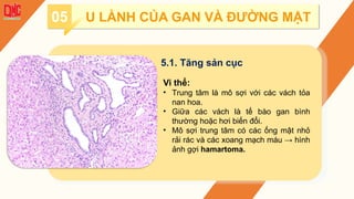 05 U LÀNH CỦA GAN VÀ ĐƯỜNG MẬT
5.1. Tăng sản cục
Vi thể:
• Trung tâm là mô sợi với các vách tỏa
nan hoa.
• Giữa các vách là tế bào gan bình
thường hoặc hơi biến đổi.
• Mô sợi trung tâm có các ống mật nhỏ
rải rác và các xoang mạch máu → hình
ảnh gợi hamartoma.
 